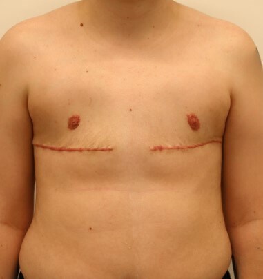 Mastectomy  Surgery After