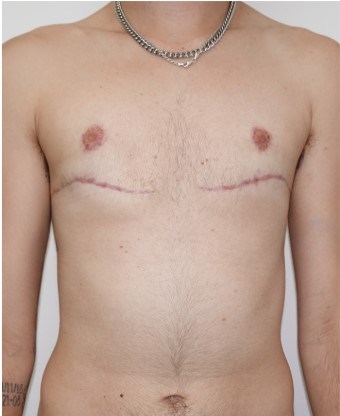 Mastectomy  Surgery After