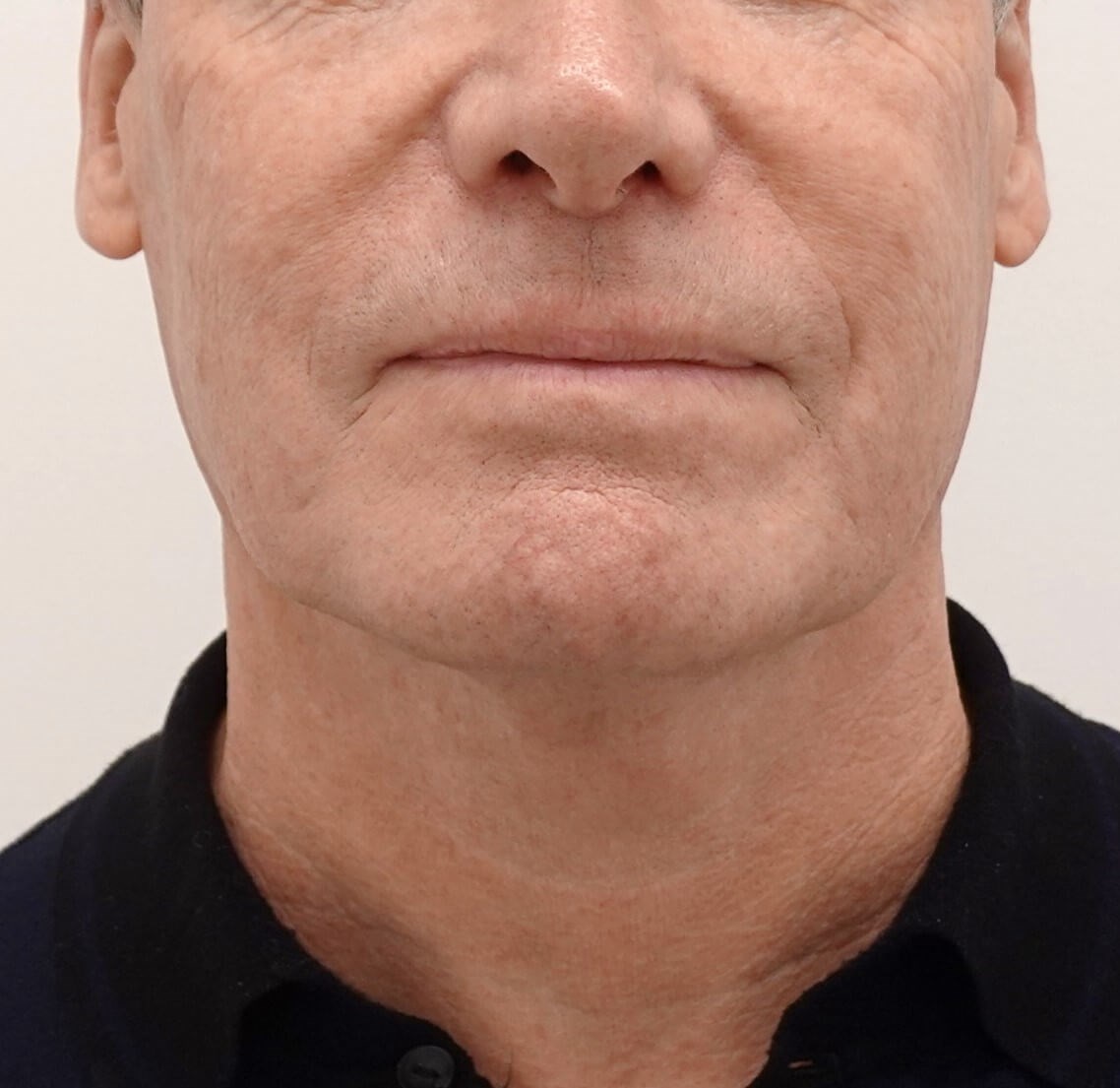 Facelift Surgery Before