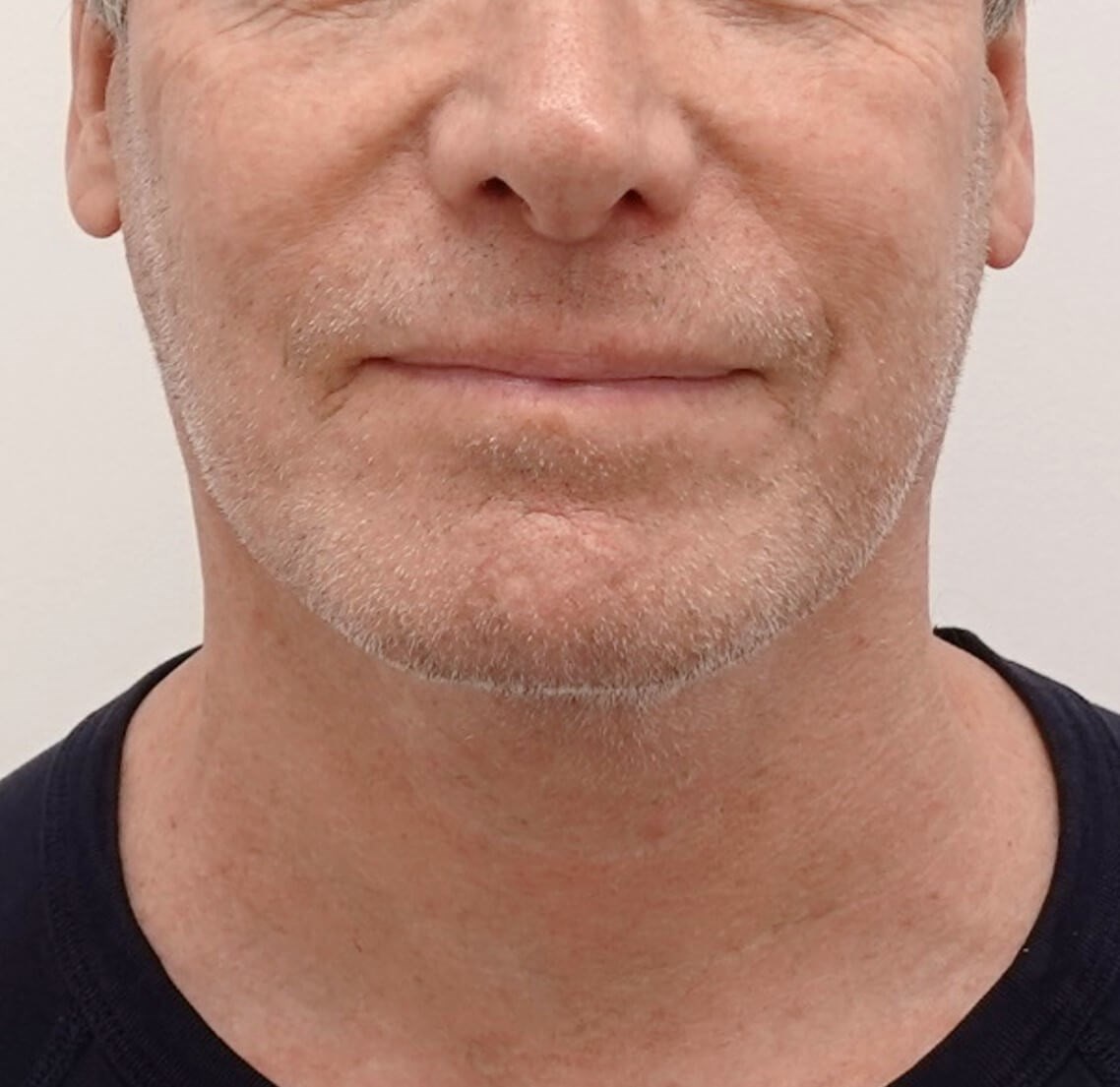 Facelift Surgery After