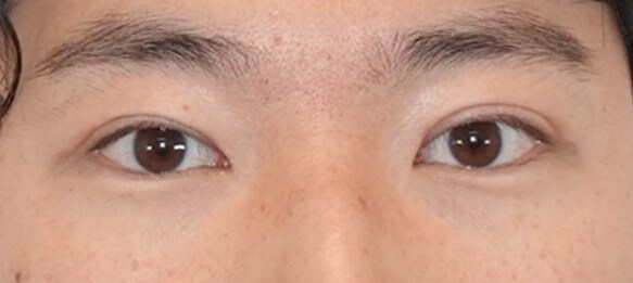 Asian Eyelid Surgery After