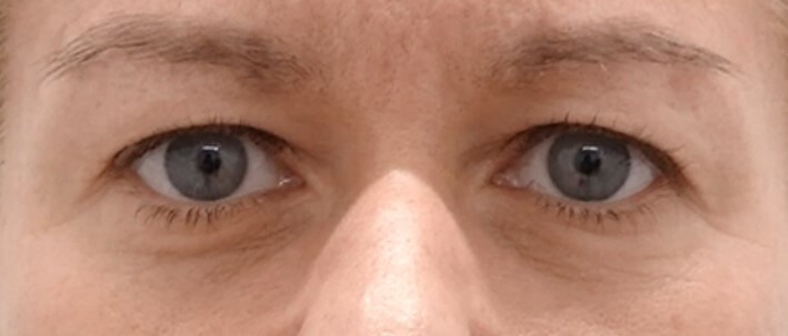 Upper Eyelid Surgery Before