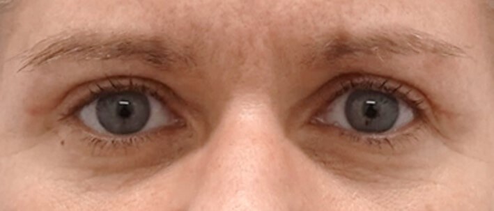 Upper Eyelid Surgery After