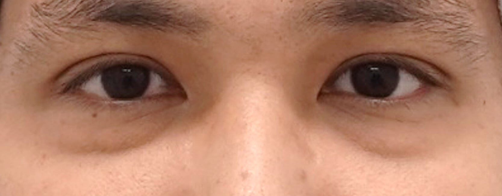 Lower Eyelid Surgery Before