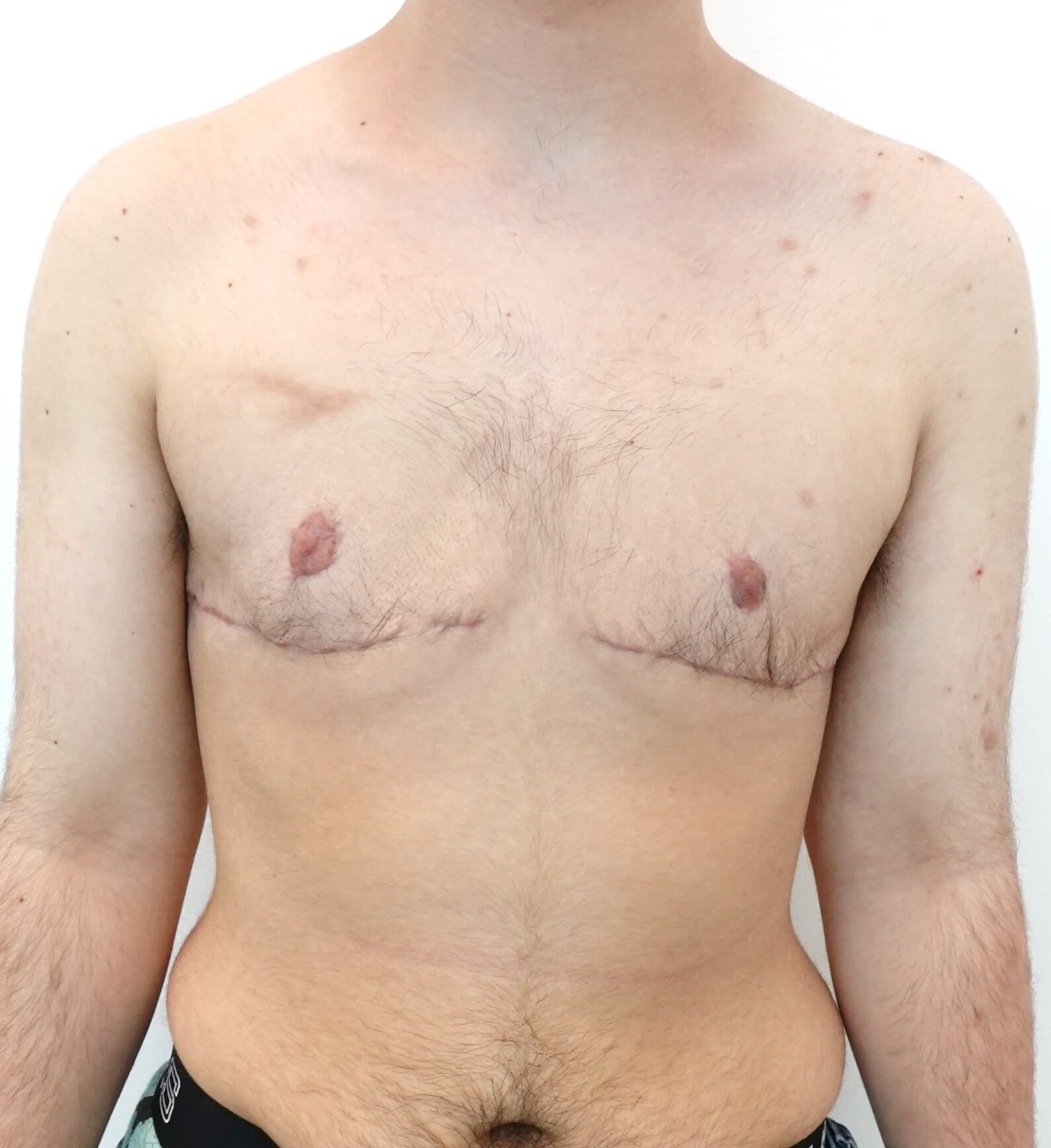 Mastectomy Surgery After
