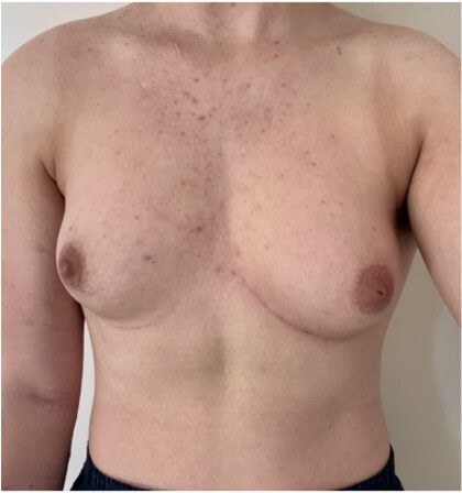Mastectomy Surgery Before