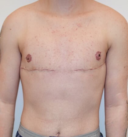 Mastectomy Surgery After