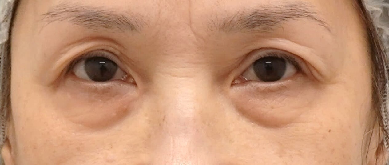 Upper and Lower Eye Surgery Before