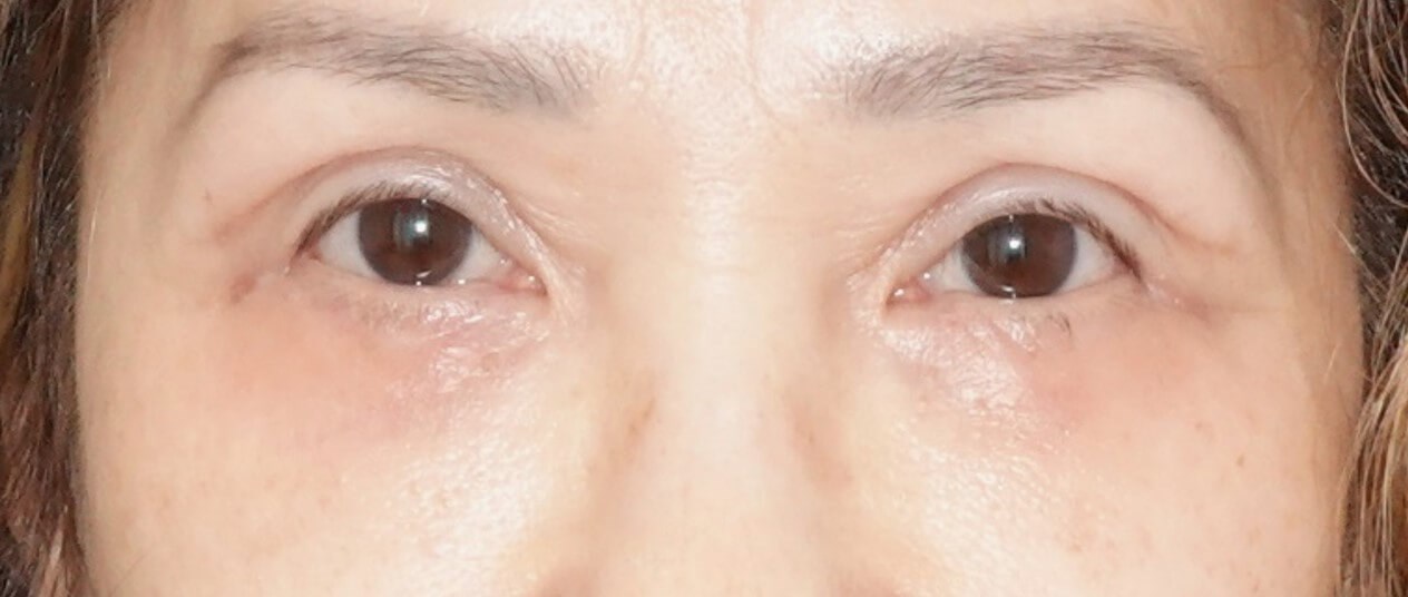 Upper and Lower Eye Surgery After