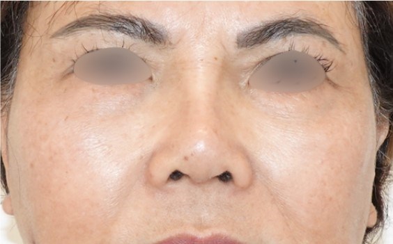 Rhinoplasty Surgery After