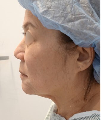 Facelift Surgery Before
