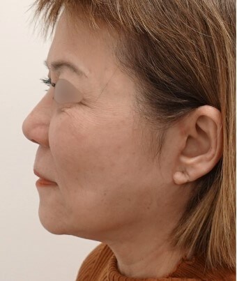 Facelift Surgery After
