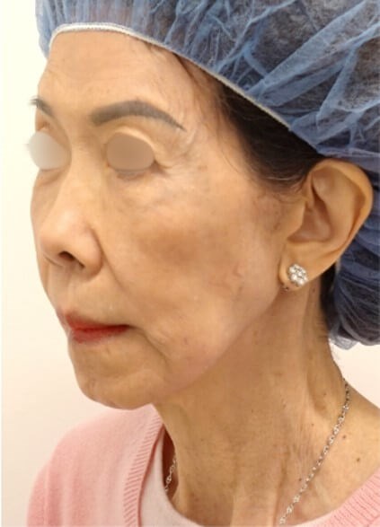 Facelift Surgery Before