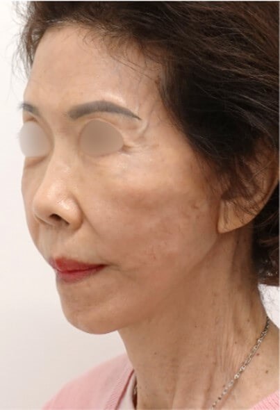 Facelift Surgery After