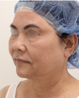 Facelift Surgery Before