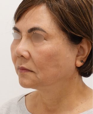 Facelift Surgery After