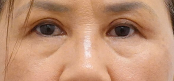 Asian Eyelid Surgery After