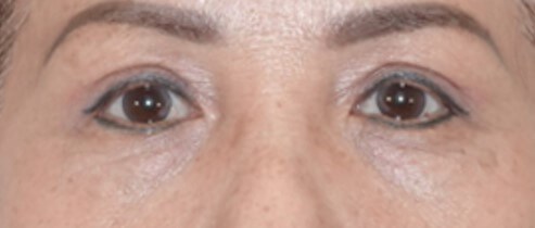 Upper Eyelid Surgery After