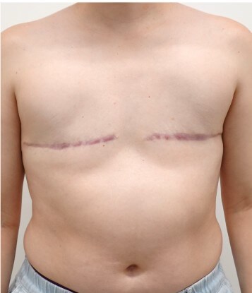 Mastectomy Surgery After