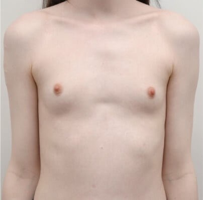 Breast Augmentation Before