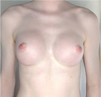 Breast Augmentation After