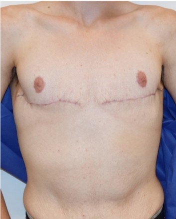 Mastectomy Surgery After