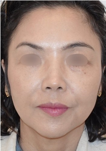 Lower Eyelid and Cheek Lift After