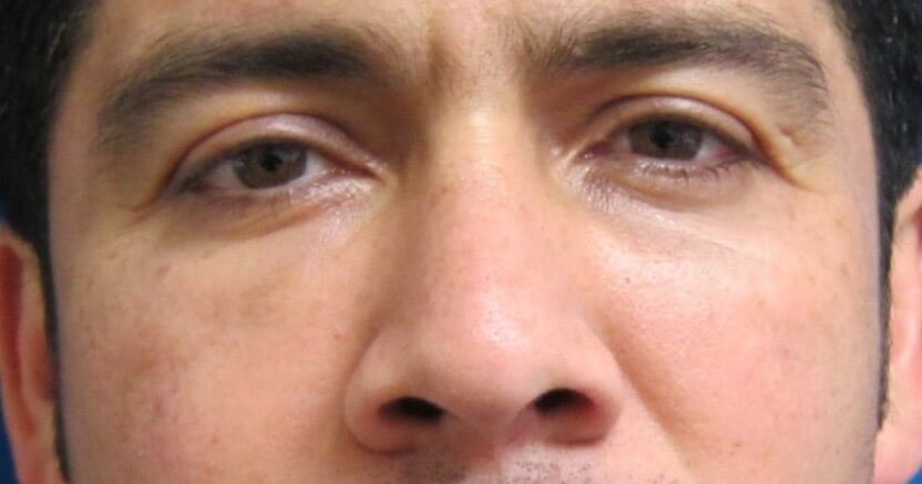 Facial Fat Grafting Surgery After