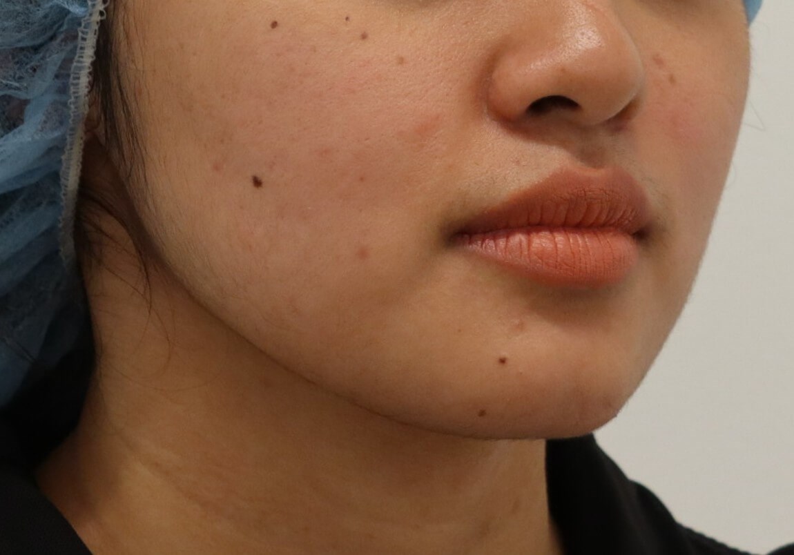 Buccal Fat Removal Before