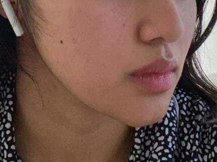 Buccal Fat Removal After