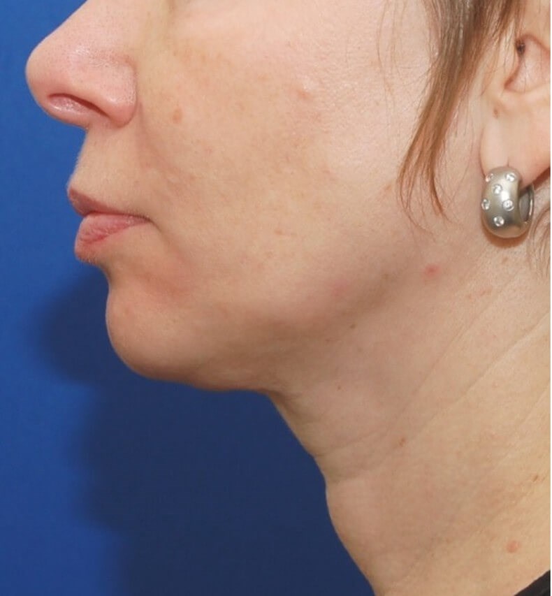 Neck Liposuction Surgery After