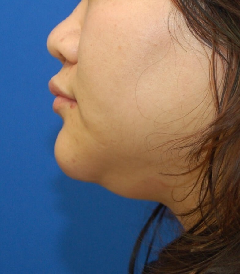 Neck Liposuction Surgery Before