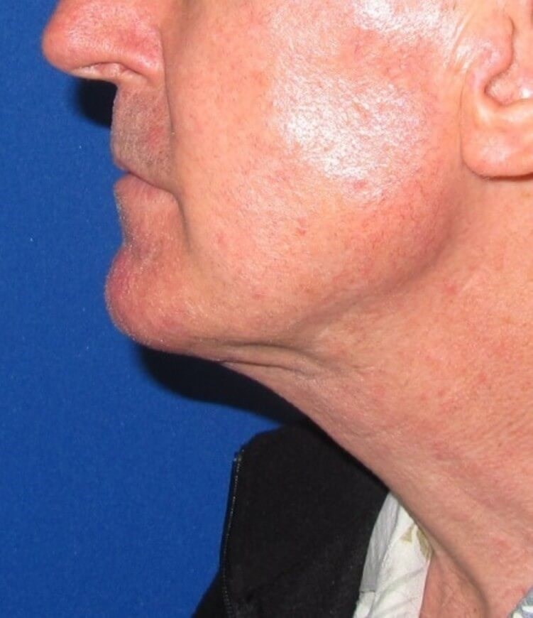 Neck Lift Surgery After