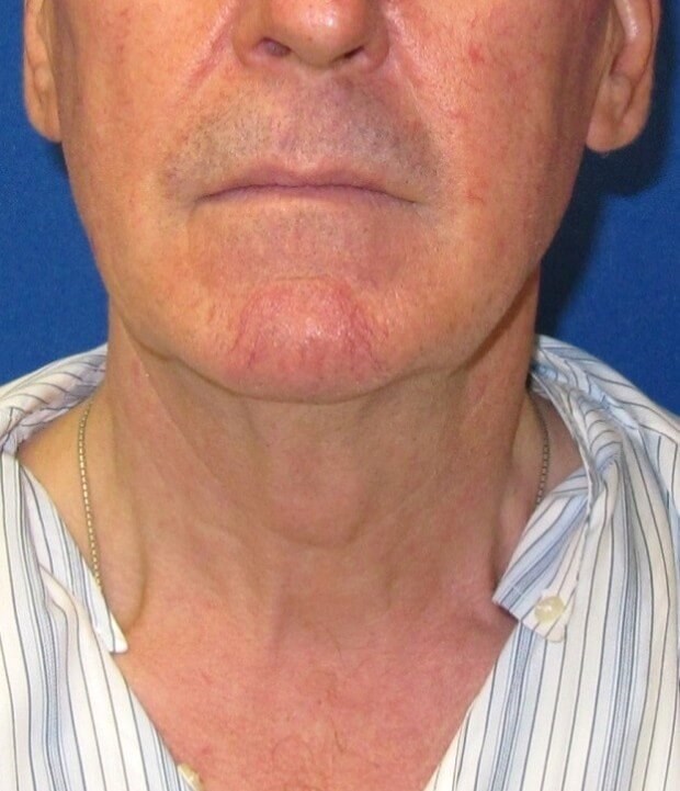 Neck Lift Surgery Before
