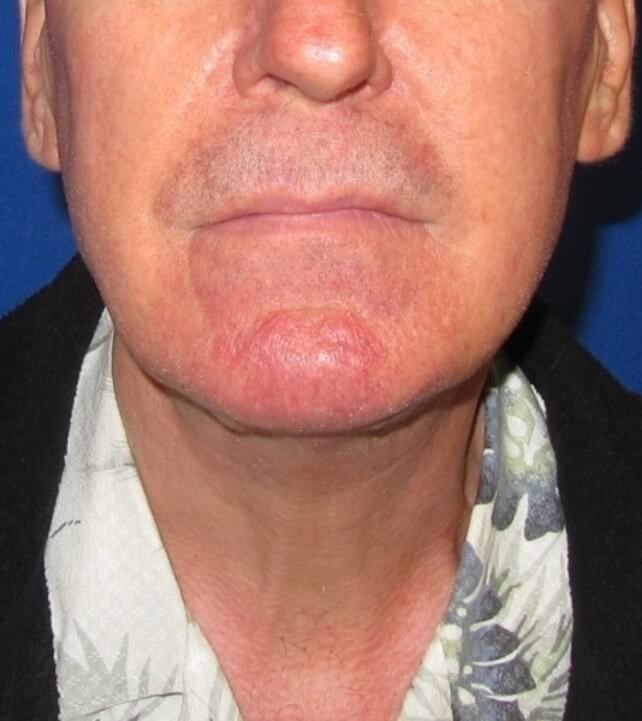 Neck Lift Surgery After