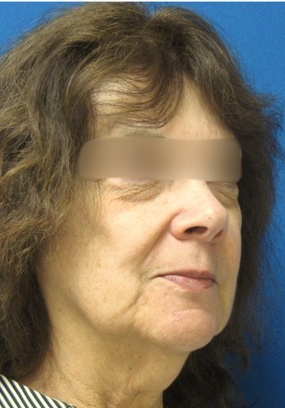 Face Lift Before