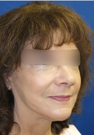 After Image