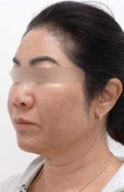 Facelift Surgery Before