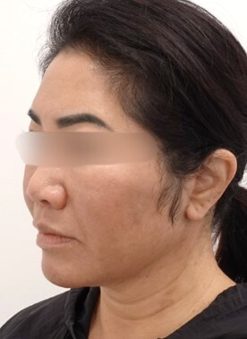 Facelift Surgery After