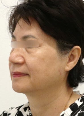 Facelift Surgery Before