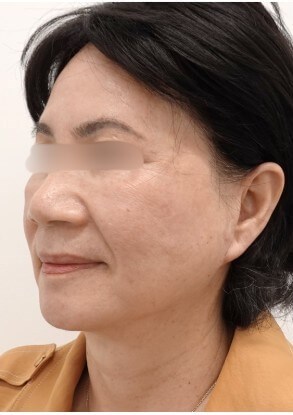 Facelift Surgery After