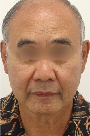 Facelift and Buccal Surgery Before