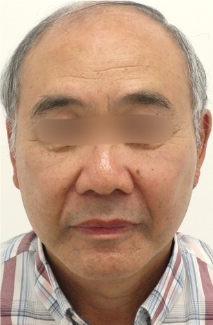 Facelift and Buccal Surgery After