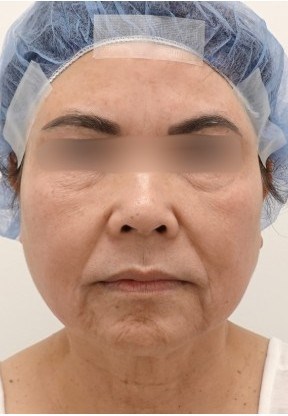 Facelift Surgery Before