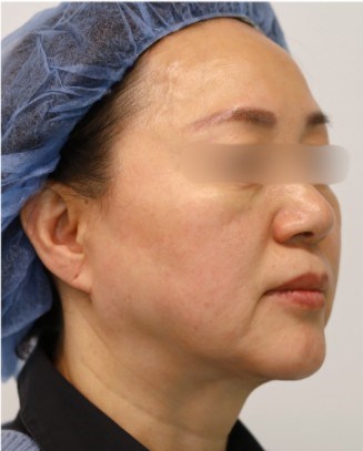 Facelift Surgery Before