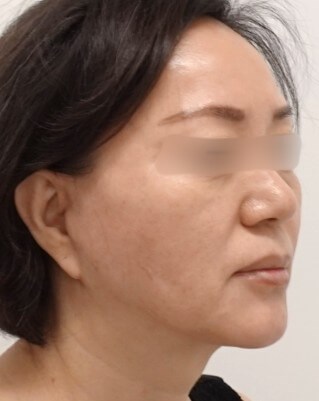 Facelift Surgery After