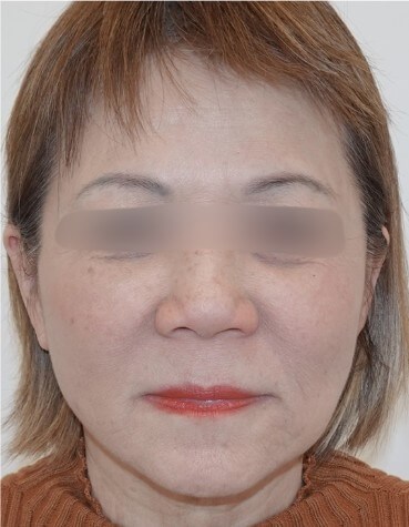 Facelift Surgery After