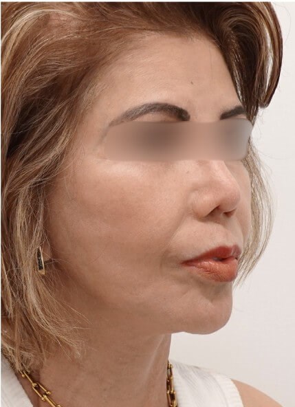 Facelift Surgery After