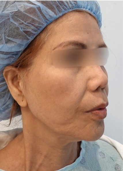 Facelift Surgery Before