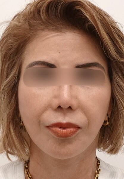 Facelift Surgery After